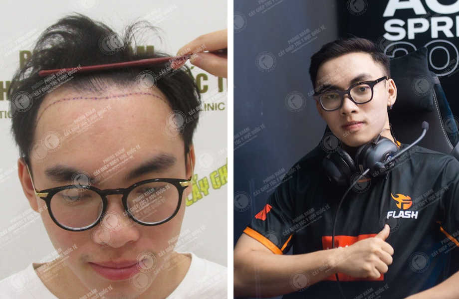  Trần Quang Hiệp (ProE) - Cấy tóc tự thân 1