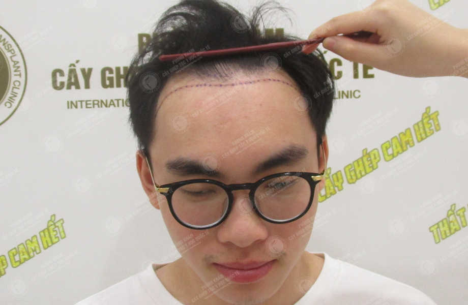 Trần Quang Hiệp (ProE) - Cấy tóc tự thân 2