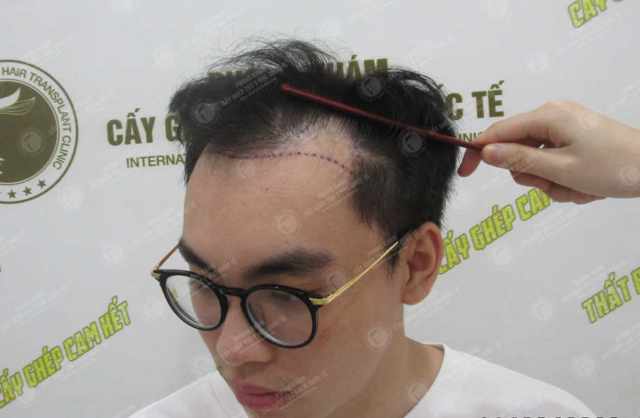 Trần Quang Hiệp (ProE) - Cấy tóc tự thân 3