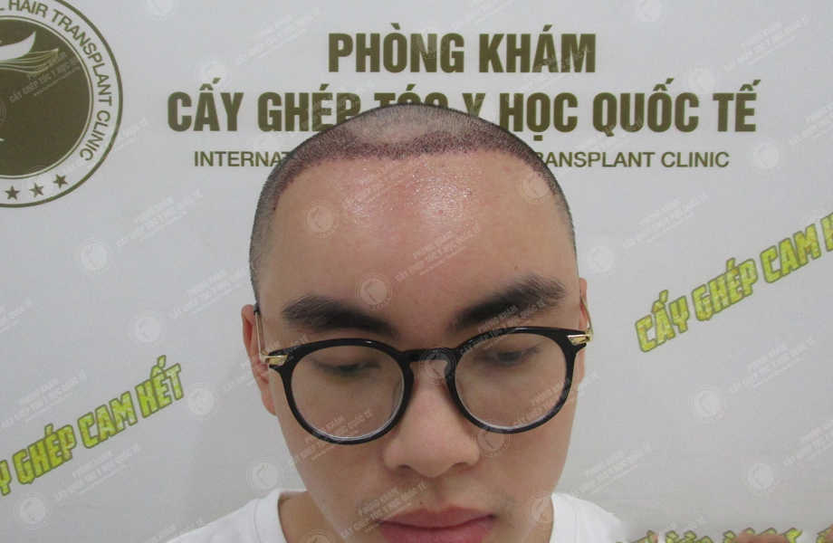 Trần Quang Hiệp (ProE) - Cấy tóc tự thân 6
