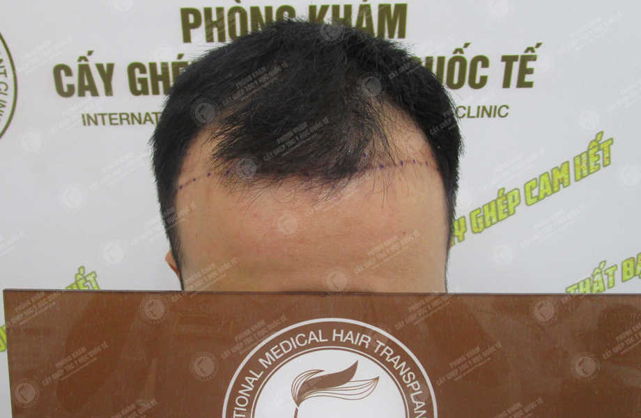 Vũ Quang Nhật - Cấy tóc đường chữ M 2