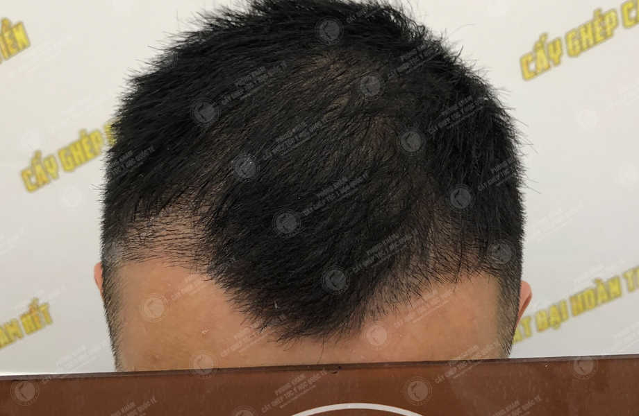 Bùi Quang Tiến - Điều chỉnh đường chân tóc 10