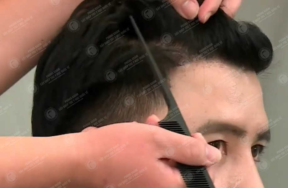 Đặng Thiên Anh - Cấy tóc tự thân 7