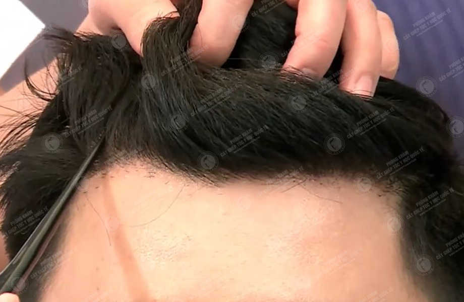 Đặng Thiên Anh - Cấy tóc tự thân 8