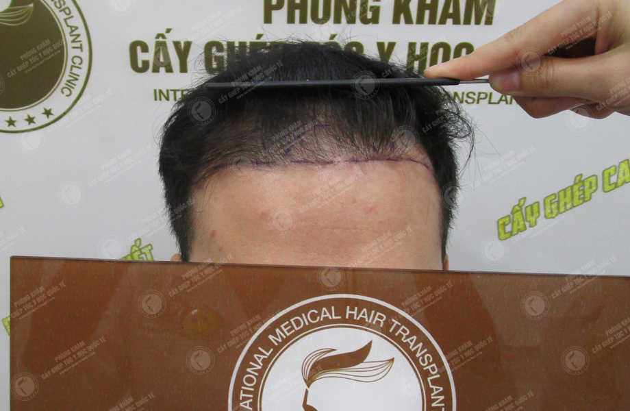 Phạm Thanh Tùng - Cấy tóc tự thân 3