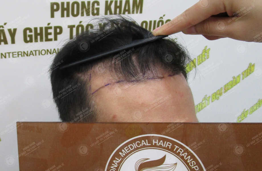 Phạm Thanh Tùng - Cấy tóc tự thân 4