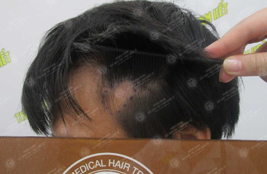 Phạm Thế Kiệt - Cấy tóc trên sẹo 2