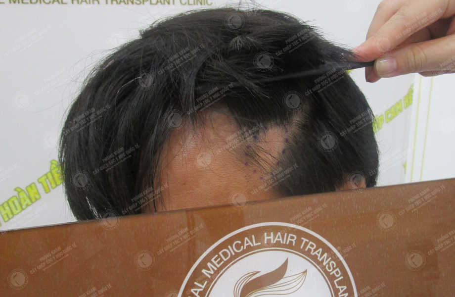Phạm Thế Kiệt - Cấy tóc trên sẹo 3