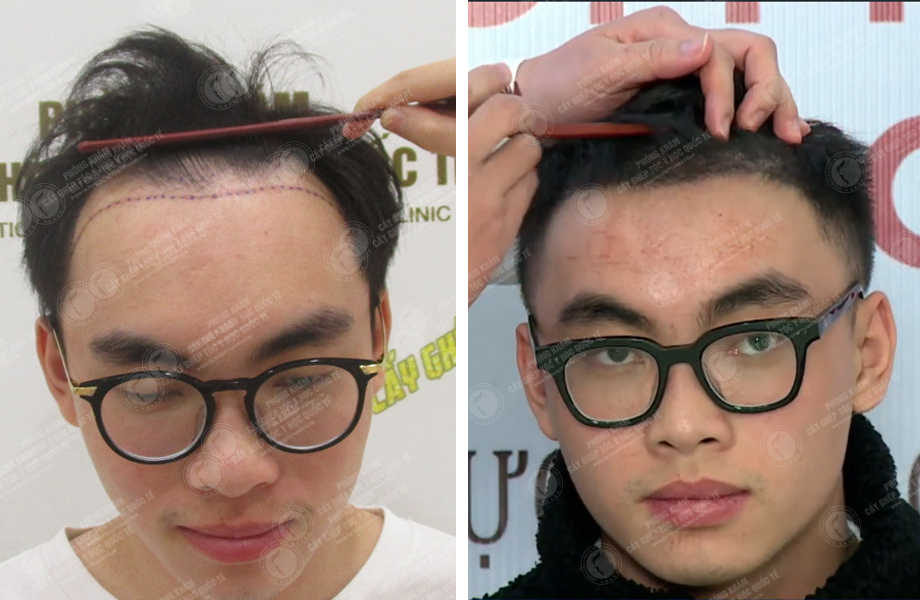 Đại dịch hói đầu tấn công đàn ông Trung Quốc dịch vụ chăm sóc và cấy tóc  mọc lên như nấm sau mưa