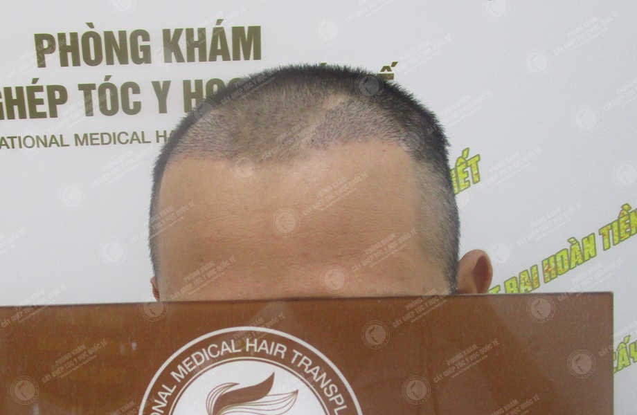 Trịnh Xuân Phong - Cấy tóc tự thân 8