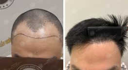 Vương Quốc Anh - Cấy tóc tự thân