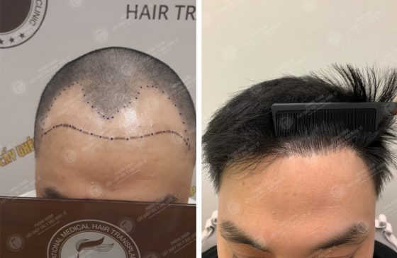 Vương Quốc Anh - Cấy tóc tự thân