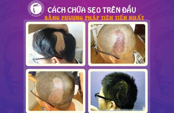 cách xóa và làm mờ sẹo trên da đầu