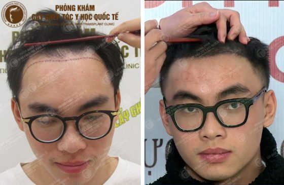 hiệp proe review sau 6 tháng cấy tóc