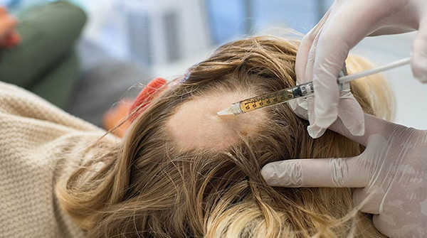 Rụng tóc từng mảng Nguyên nhân  cách điều trị bệnh hiệu quả