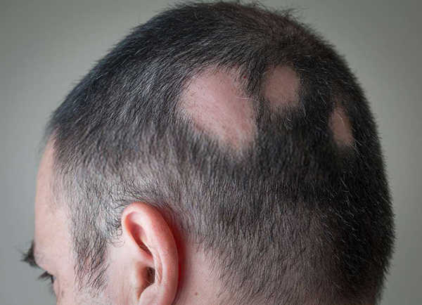 Rụng tóc nhiều ở nam giới là bệnh gì Địa chỉ chữa rụng tóc uy tín