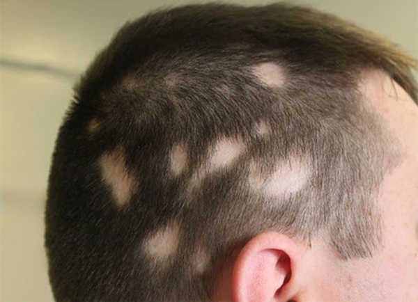 Bệnh rụng tóc từng mảng có nguy hiểm không và cách trị nào hiệu quả nhất   Blog