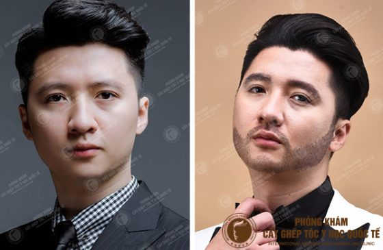 Trọng Hưng cấy râu