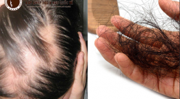 chữa khỏi rụng tóc