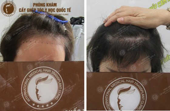 kích thích mọc tóc
