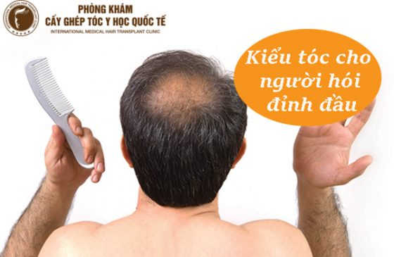 Kiểu tóc cho người hói đỉnh đầu