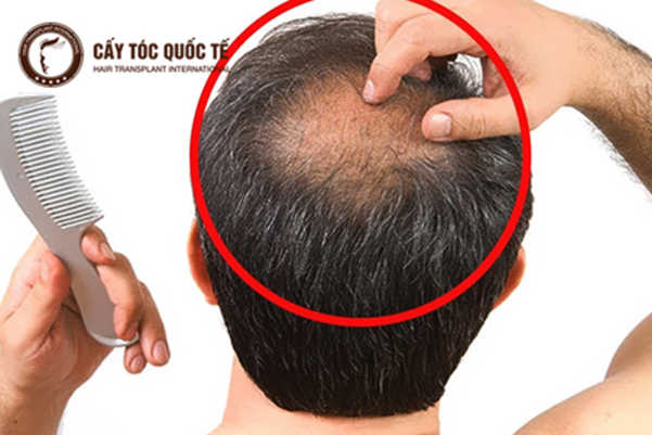 Kiểu tóc cho người hói đỉnh đầu