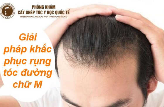 rụng tóc đường chữ m