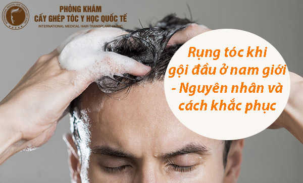 Nguyên nhân gây rụng tóc ở nam giới và cách chữa hiệu quả