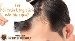 trị hói trán bằng cách nào