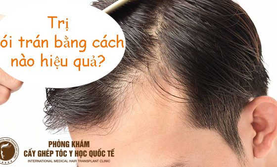 trị hói trán bằng cách nào