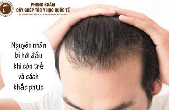 bị hói đầu khi còn trẻ