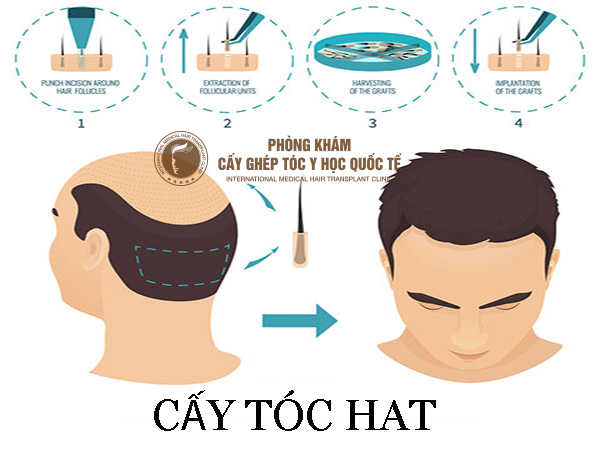 Cấy tóc HAT có hiệu quả không