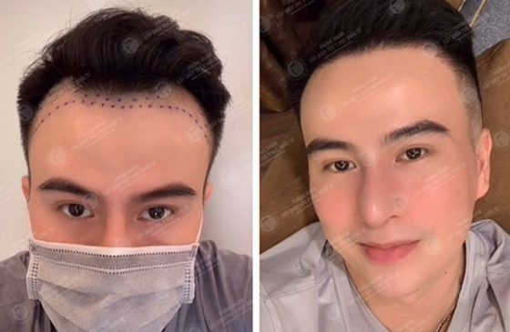 cấy tóc tự thân có hiệu quả không