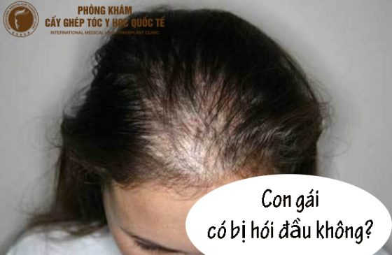 con gái có bị hói đầu không