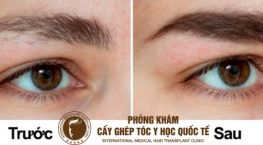 kích thích mọc lông mày