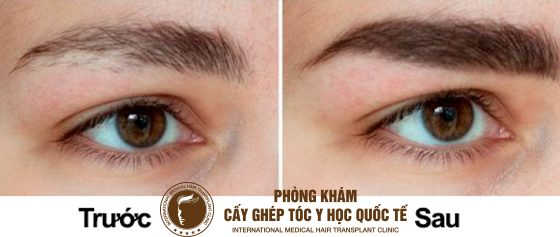 kích thích mọc lông mày