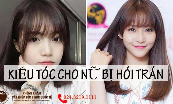 kiểu tóc cho nữ bị hói trán, kiểu tóc che hói cho nữ, kiểu tóc cho người hói nữ, kiểu tóc cho người hói chữ m nữ, kiểu tóc cho nữ bị hói trán, kiểu tóc che hói, tóc mái che hói,