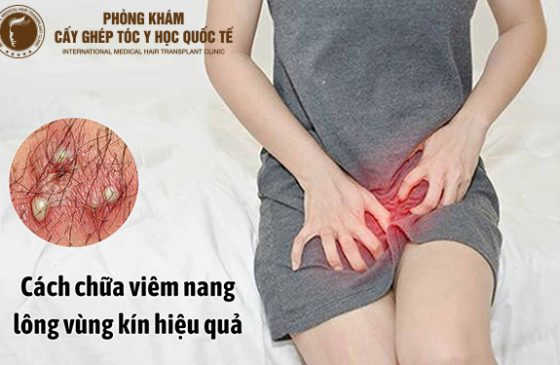 nang lông vùng kín nổi mụn