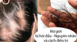 Nữ giới bị hói đầu