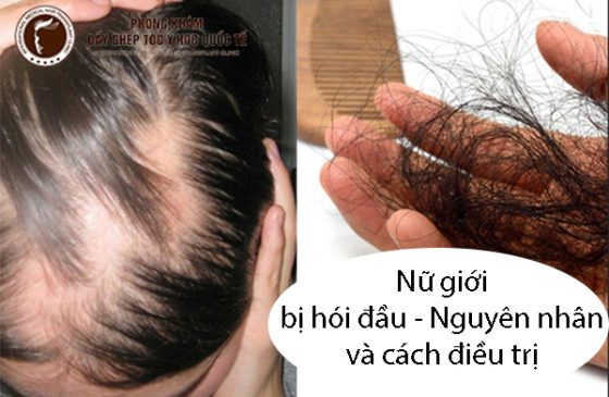 Nữ giới bị hói đầu
