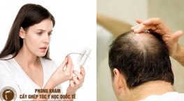 cách chữa trị tóc hói