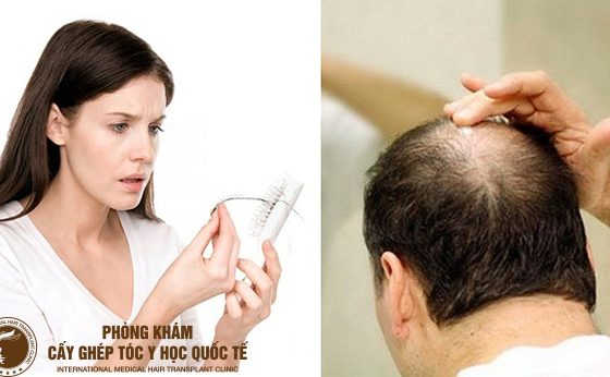 cách chữa trị tóc hói