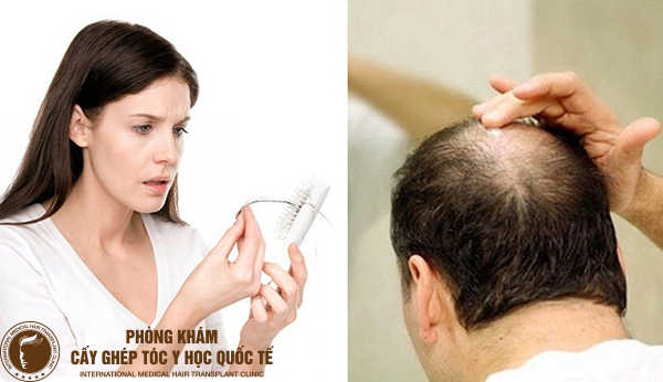 Các nguyên nhân gây rụng tóc ở nam giới  Vinmec