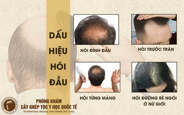 cách chữa trị tóc hói