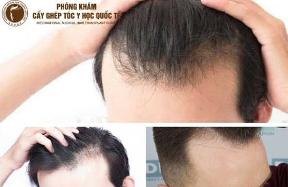 trán chữ m cắt tóc gì