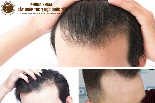 43 Kiểu Tóc Nam Cho Đầu Hói ý tưởng  kiểu tóc nam kiểu tóc tóc nam