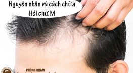 cách chữa hói chữ M