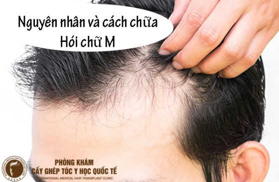 cách chữa hói chữ M
