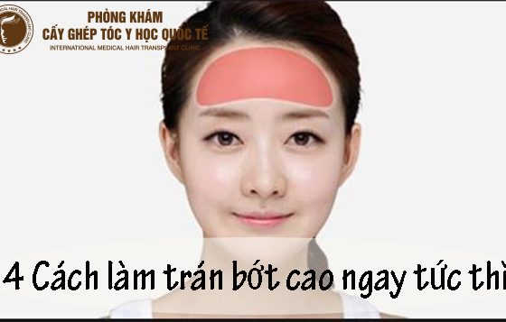 cách làm trán bớt cao
