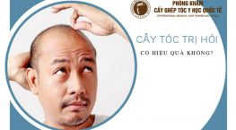 cấy tóc có thực sự hiệu quả không